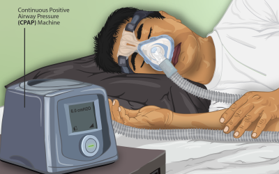Tratamiento con CPAP y sus problemas.