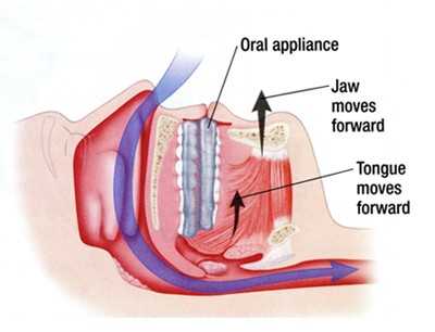 Férula avance mandibular explicación - Dr. Ferré