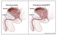 cancer de prostata y problemas del sueño