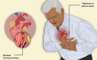 La apnea del sueño sin síntomas diurnos se asocia a mayor riesgo de enfermedad cardiovascular.